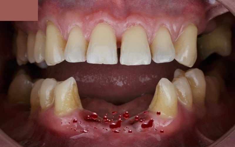 Nằm mơ thấy rụng răng đánh số may? Đánh 31 hay 50?