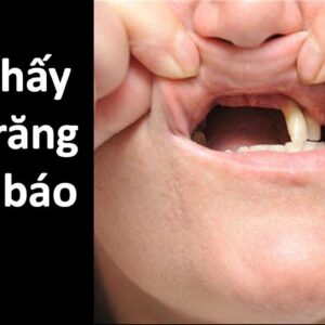 Giải mã giấc mơ răng rụng – Con số may mắn đổi đời