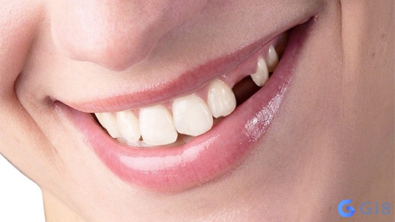 Giấc mơ thấy gãy răng không chảy máu thể hiện cho một sự biến đổi không quá lớn trong cuộc sống
