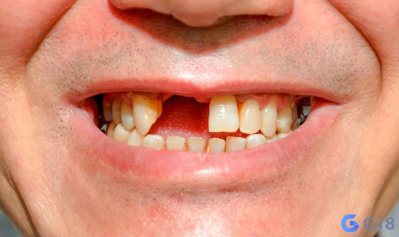 Giấc mơ thấy gãy răng cửa thể hiện cho một sự lo lắng nào đó trong bạn