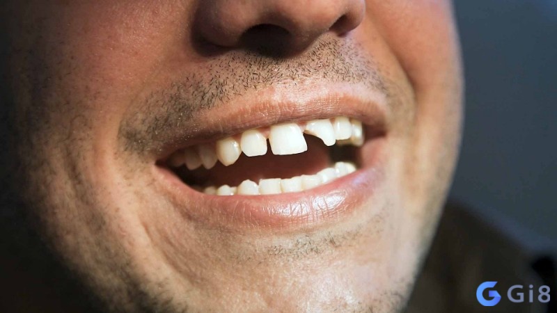 Nằm mơ thấy gãy răng đánh số mấy mang đến cho bạn nhiều con số may mắn mỗi ngày